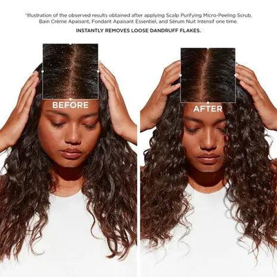 Before-and-after results of using Symbiose Routine for dandruff, showing significantly reduced flakes on the scalp.